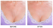 Before and after Dreambox Plump Chest Treatment Pad Model 4