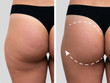JOVS EMS Toming SHorts Before and After
