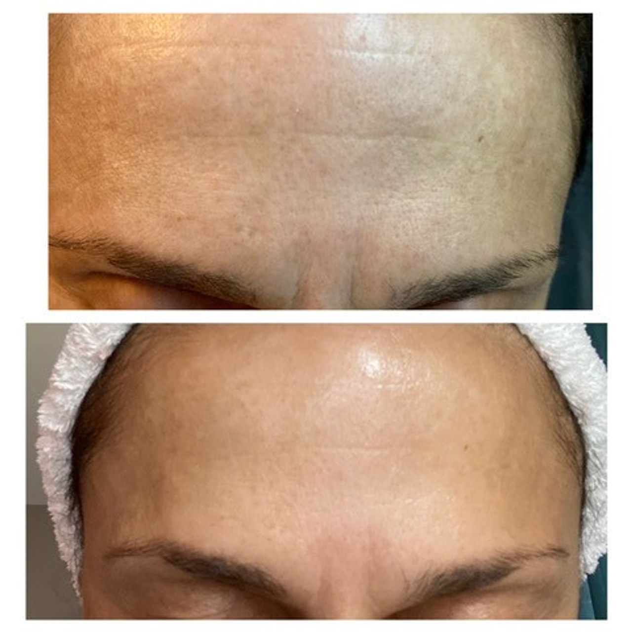 BENECELL Microneedling Regeneration System before & after forehead