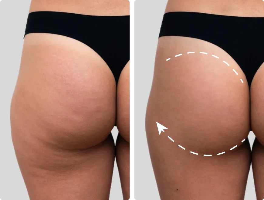 JOVS EMS Toming SHorts Before and After