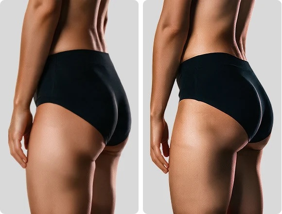 JOVS EMS Toning Shorts Before and After