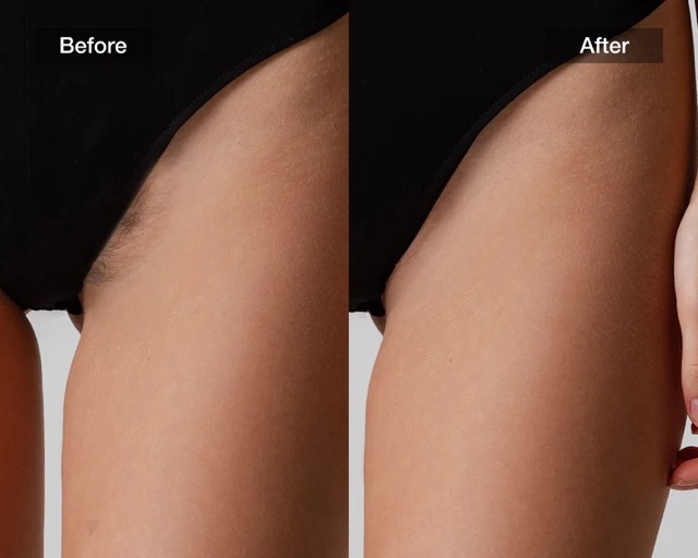 Before and after Brazilian hair reduction using the JOVS Scroll IPL Hair Removal Device