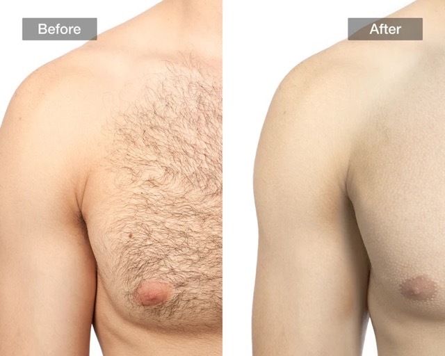 Before and after chest hair reduction using the JOVS Scroll IPL Hair Removal Device