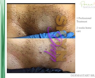 Intimate Brite Peel Before and After