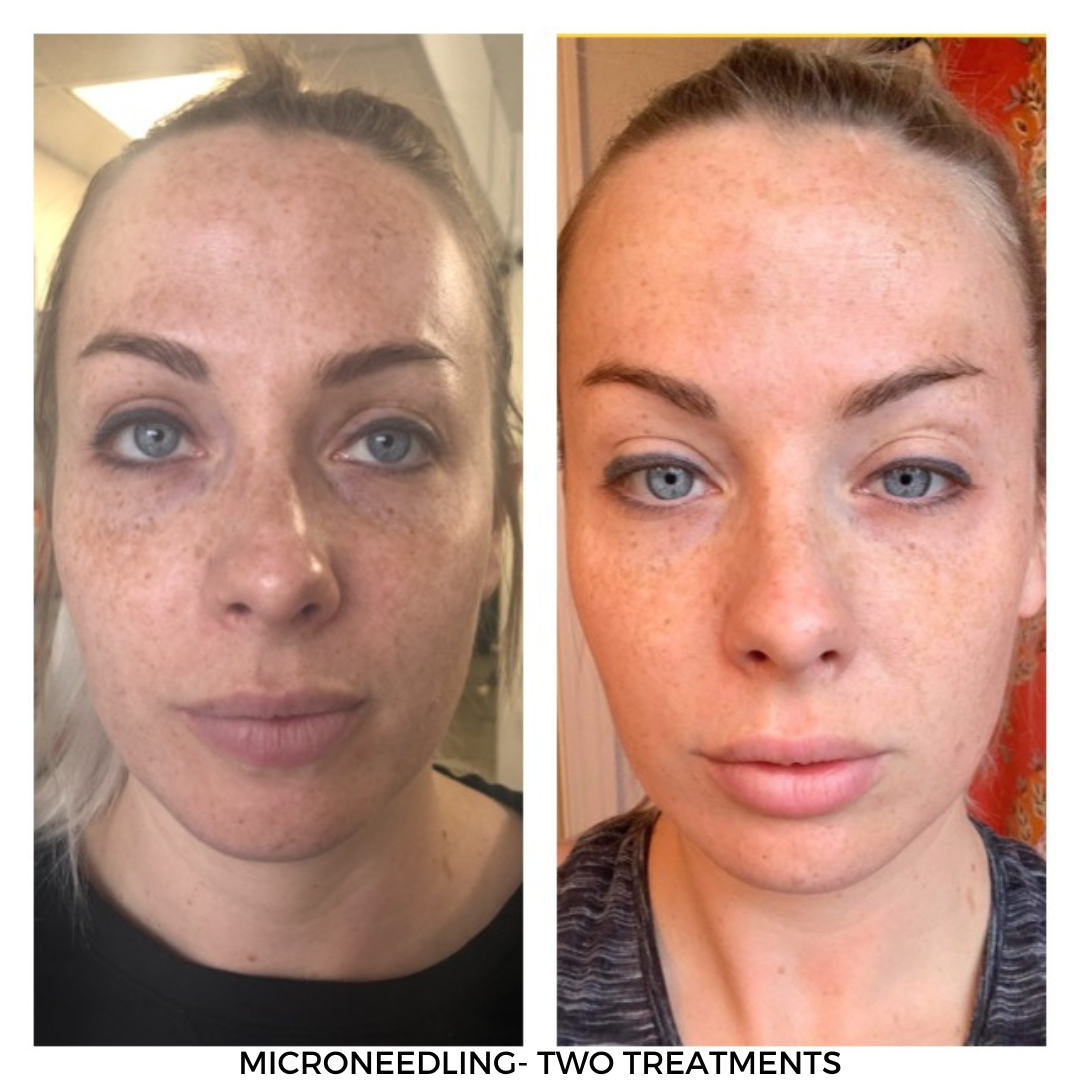 microneedling