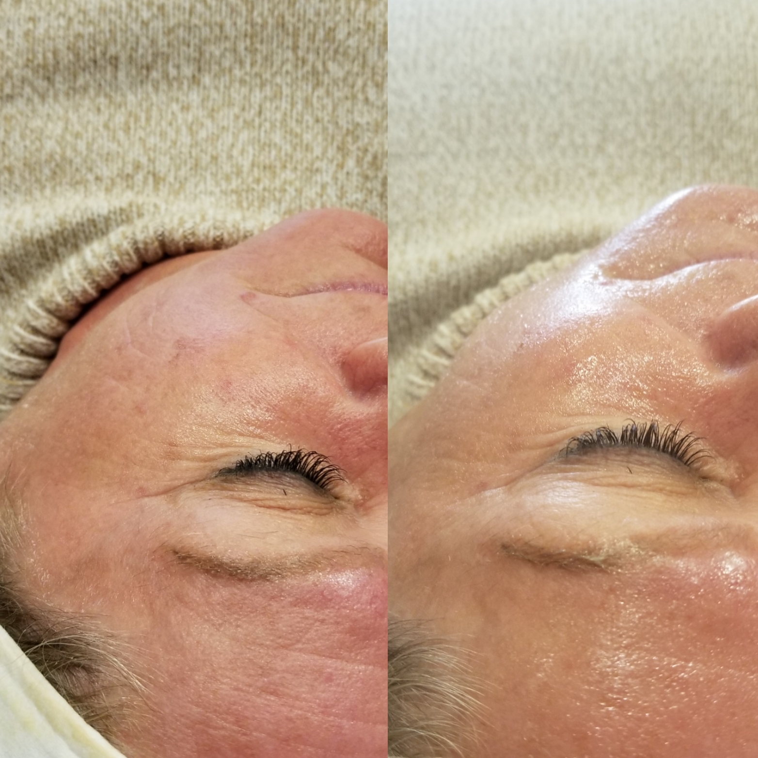 DBH V-Band Before and After 1