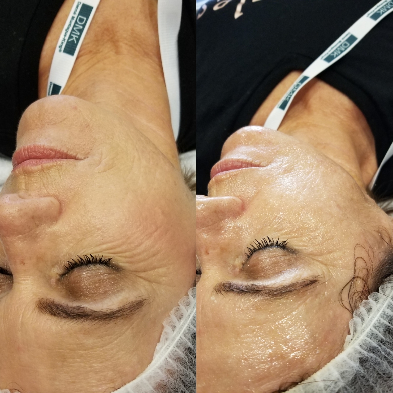 DBH V-Band Before andAfter 2