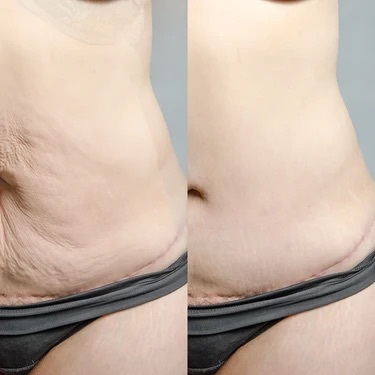 JOVS customer postpartum abdominal before-and-after photos