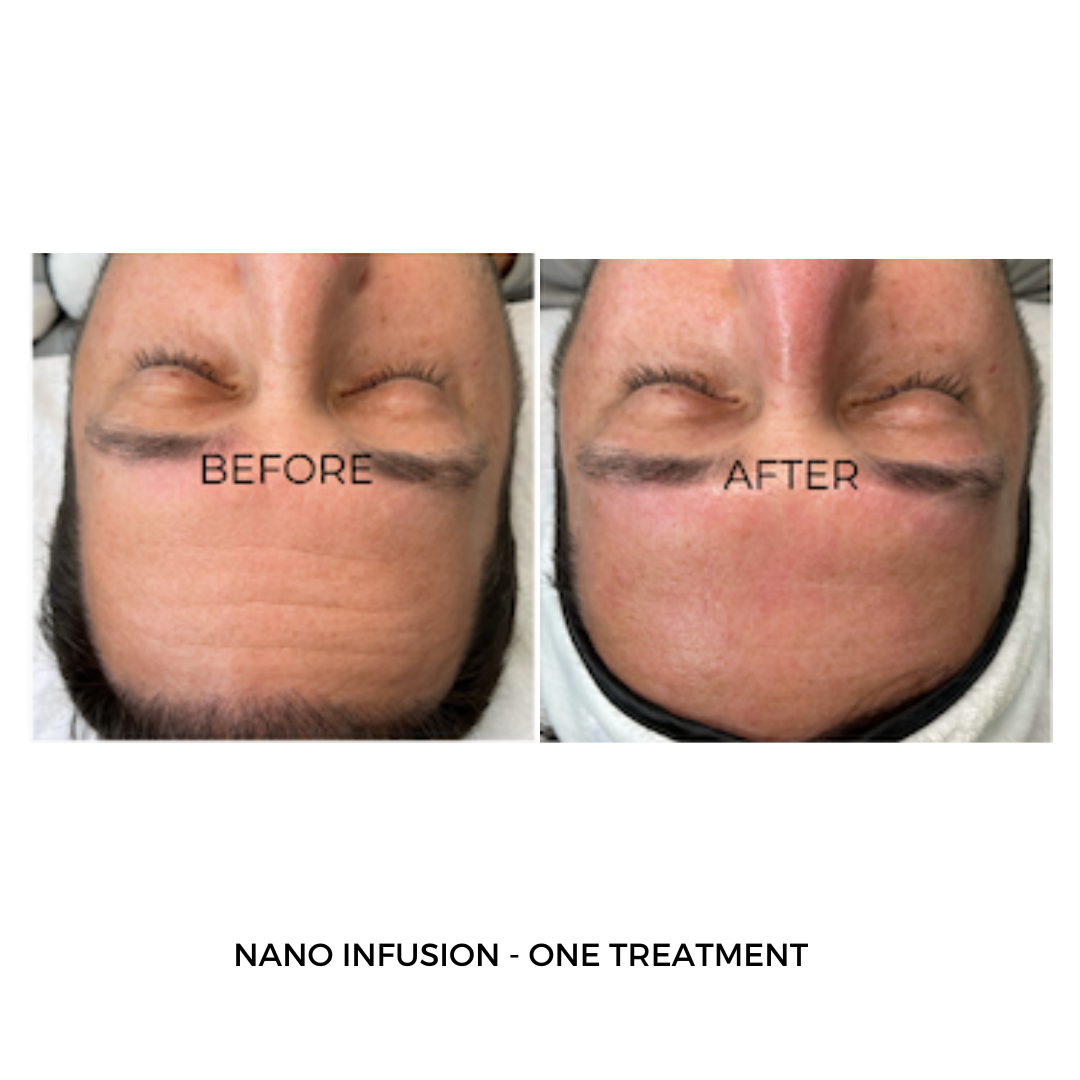 Nanopen + Oxygen Infusion Kit brightening professional use only. Shop!