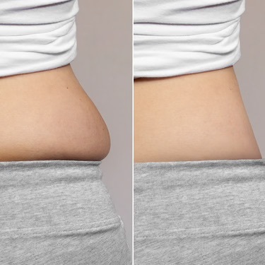 JOVS customer before-and-after waist appearance photos