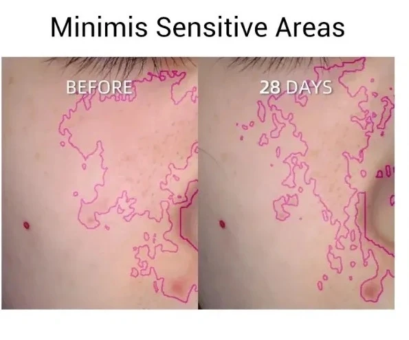 JOVS Light Therapy Panel before and after result