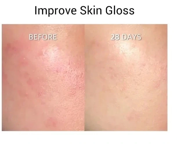 JOVS Light Therapy Panel before and after result
