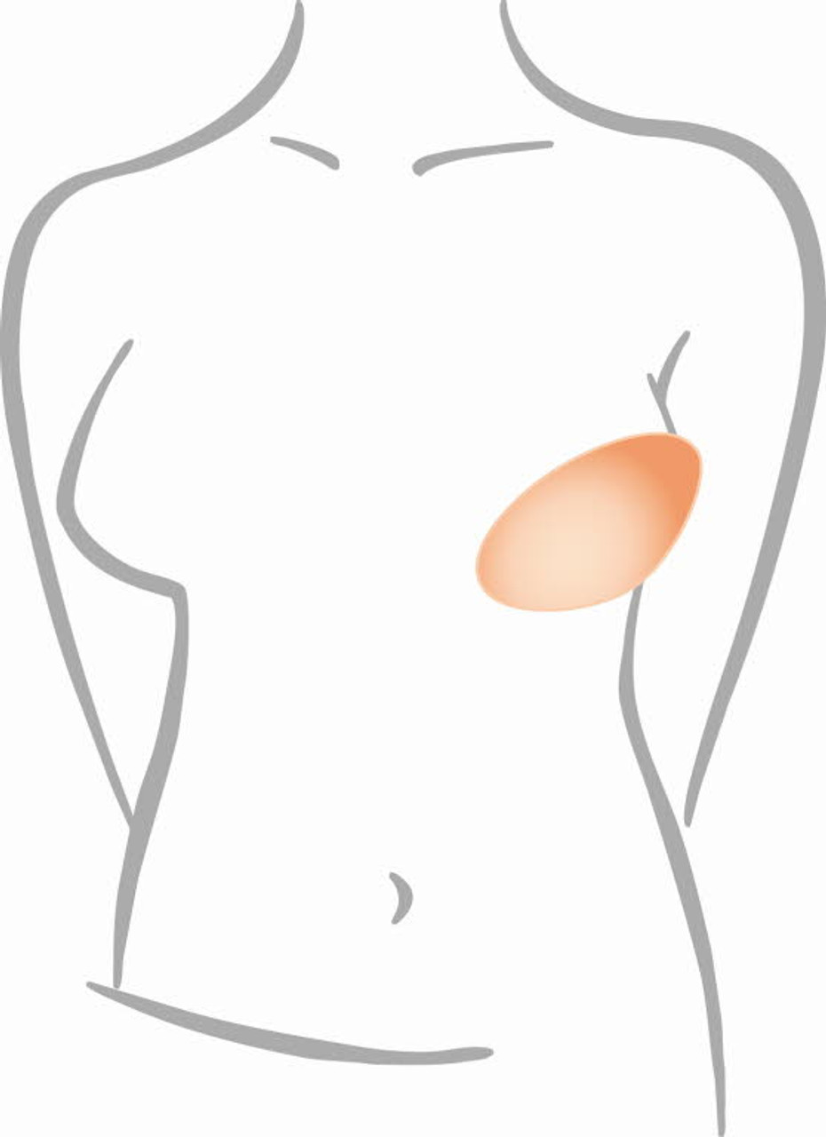 Often Unaware Solution For Uneven Breasts: Lumpectomy shapers - Amoena