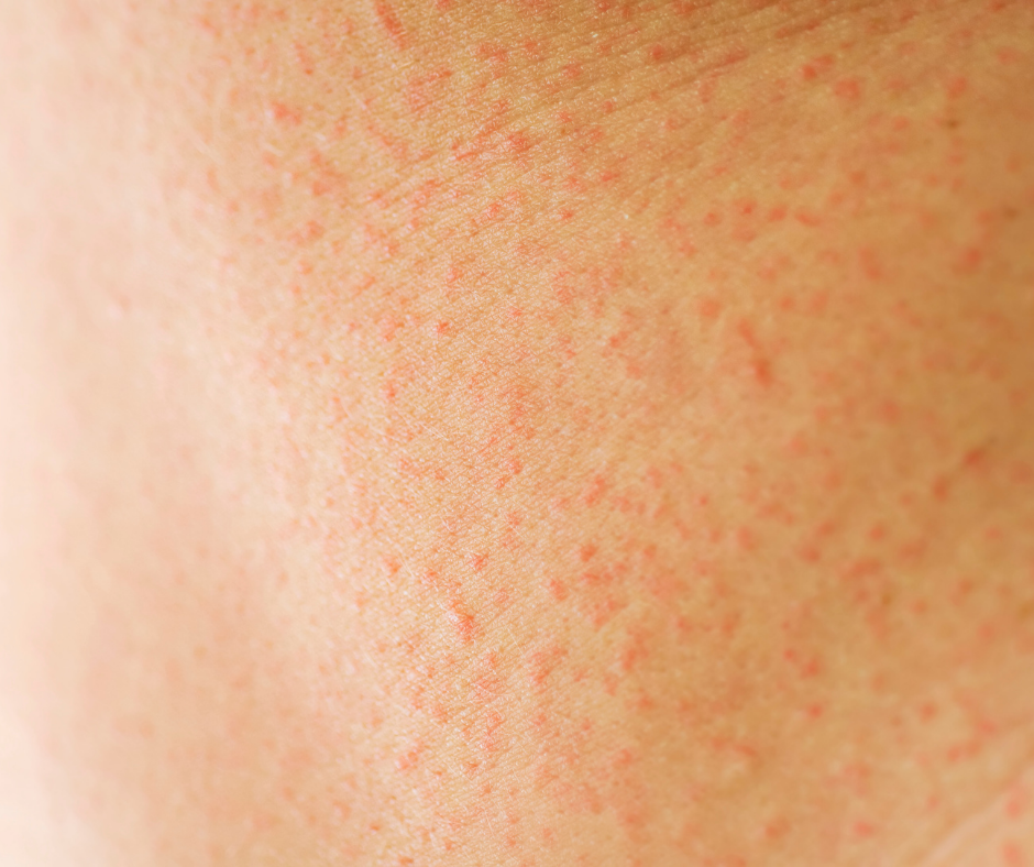 Gluten Sensitive?  Top Tips For Treating Sensitive Skin Types.