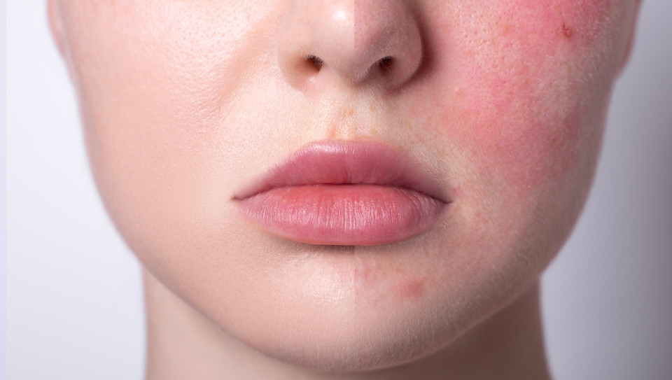 Vegan-Friendly Korean Skincare Solutions for Sensitive and Acne-Prone Skin