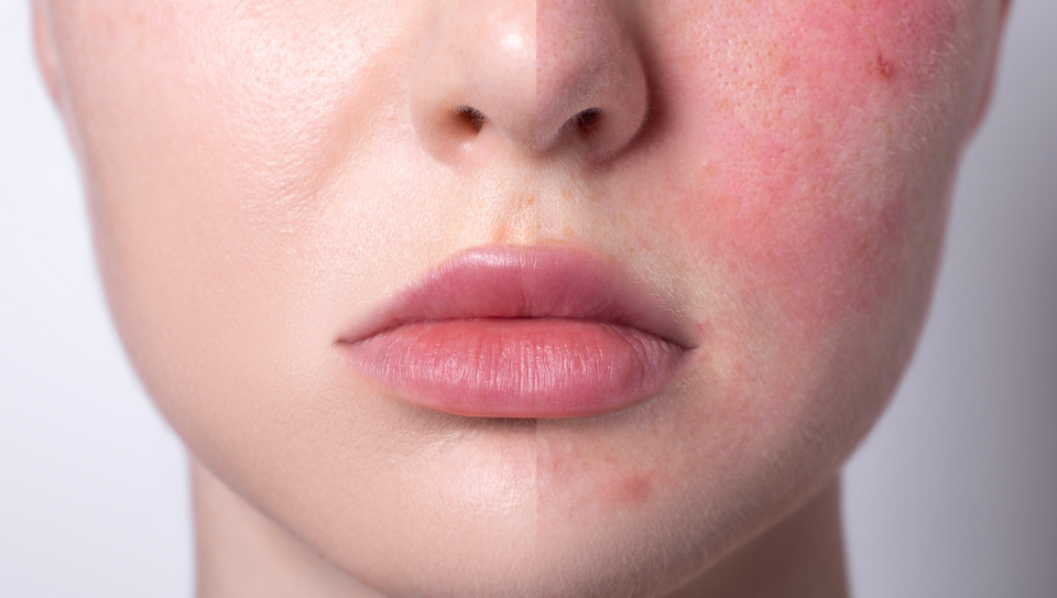 Skin Care Ingredients That Will Fade Your Redness For Good