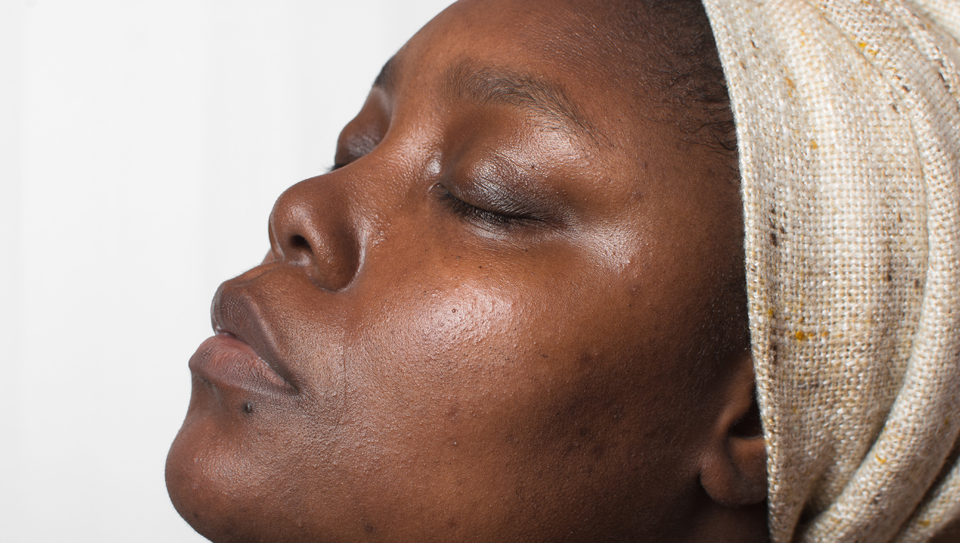 Top 5 Tranexamic Acid Serums Perfect for Hyperpigmentation
