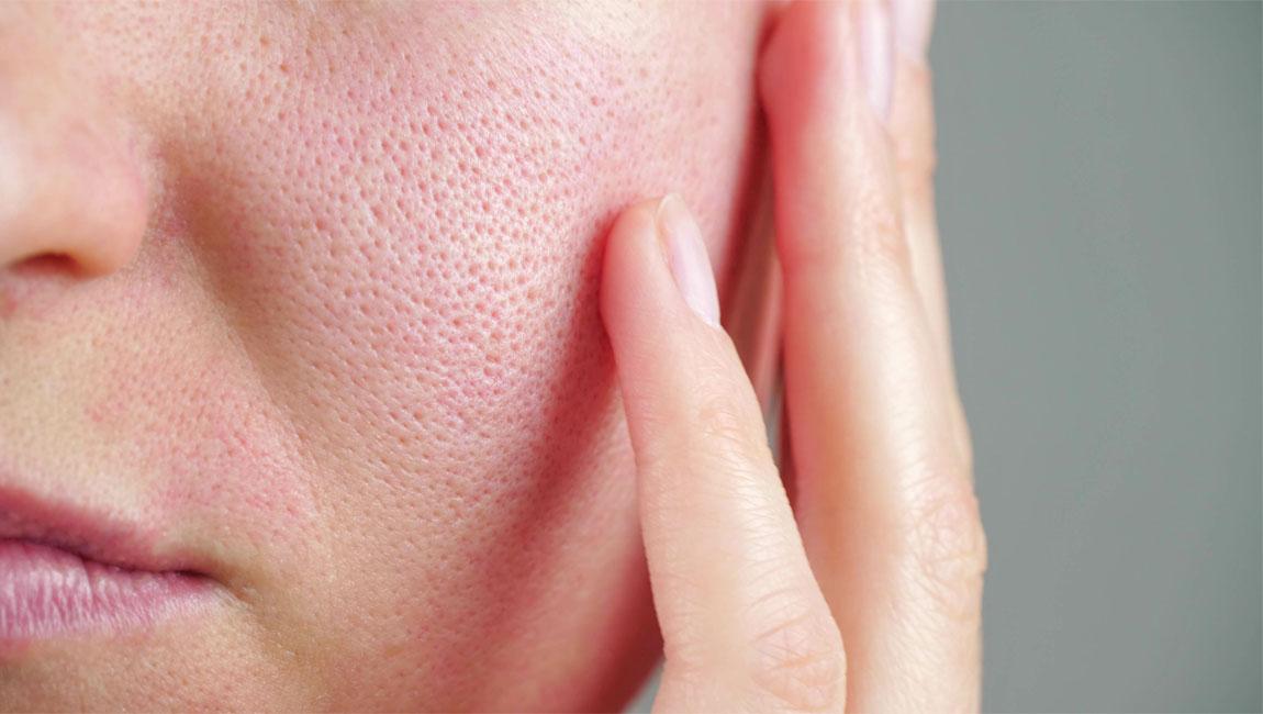 ​Get to the Bottom of Your Pores: Everything You Need to Know