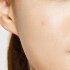 Does Moisturiser Help with Acne & Spots?