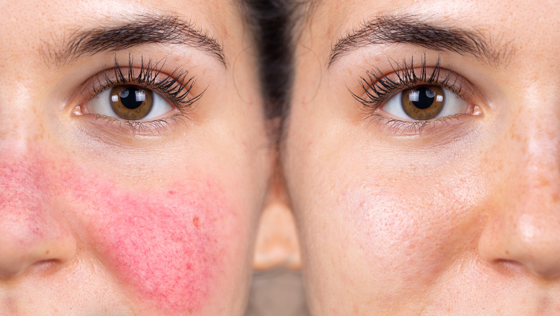 Azelaic Acid for Rosacea: How It Helps Calm Redness & Support Sensitive Skin 