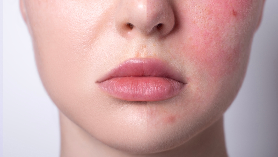 Vegan-Friendly Korean Skincare Solutions for Sensitive and Acne-Prone Skin