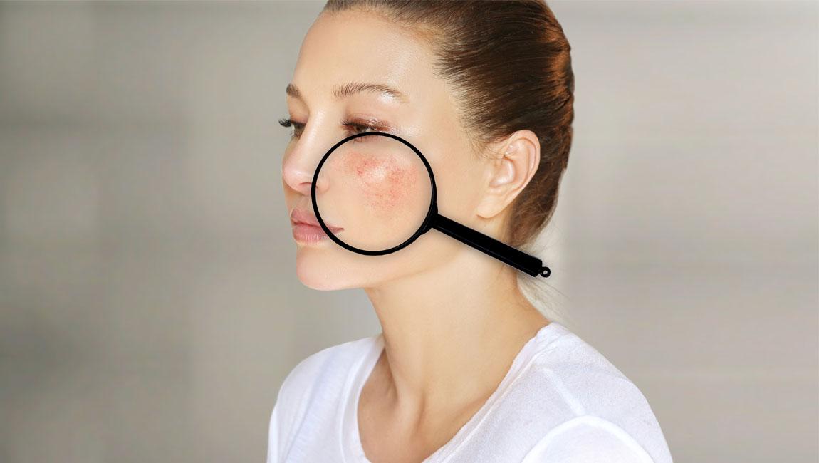 ​Environmental Stressors and Rosacea: How to Keep Your Skin Calm and Clear