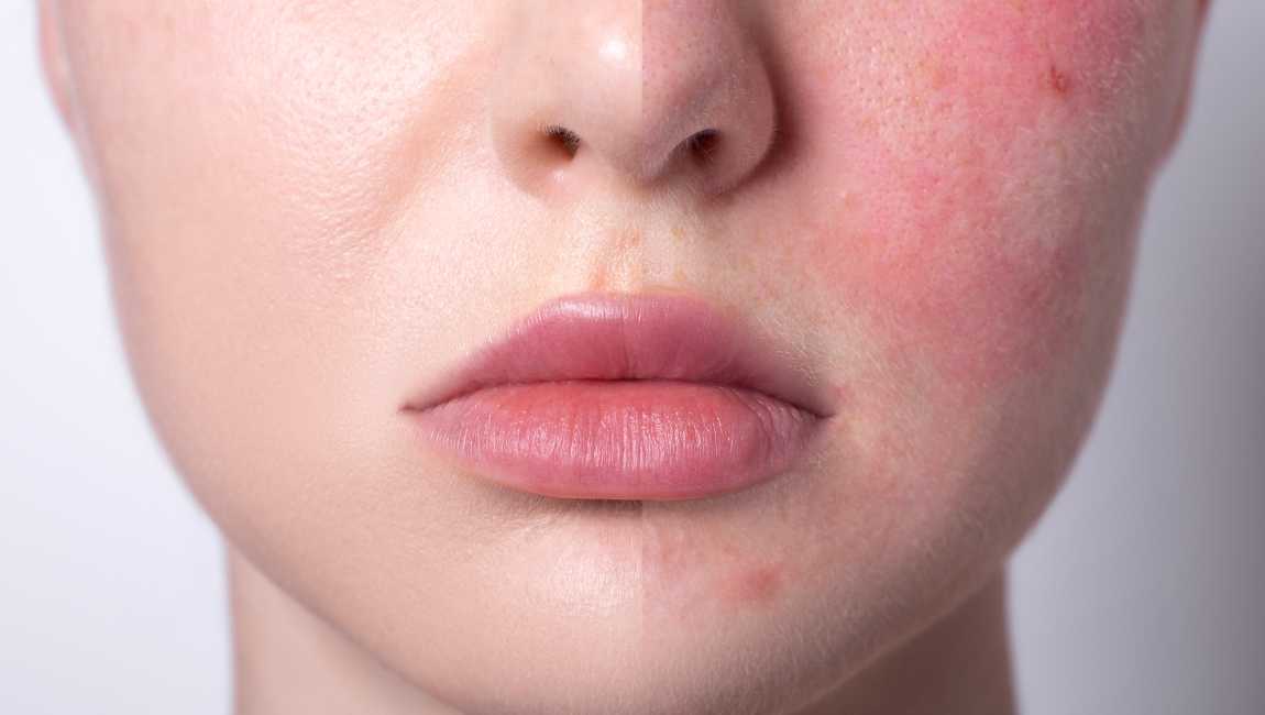 Skin Care Ingredients That Will Fade Your Redness For Good