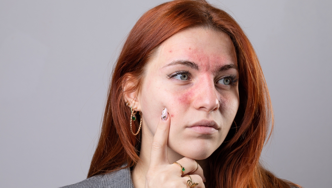 How to handle Rosacea prone skin during summer?