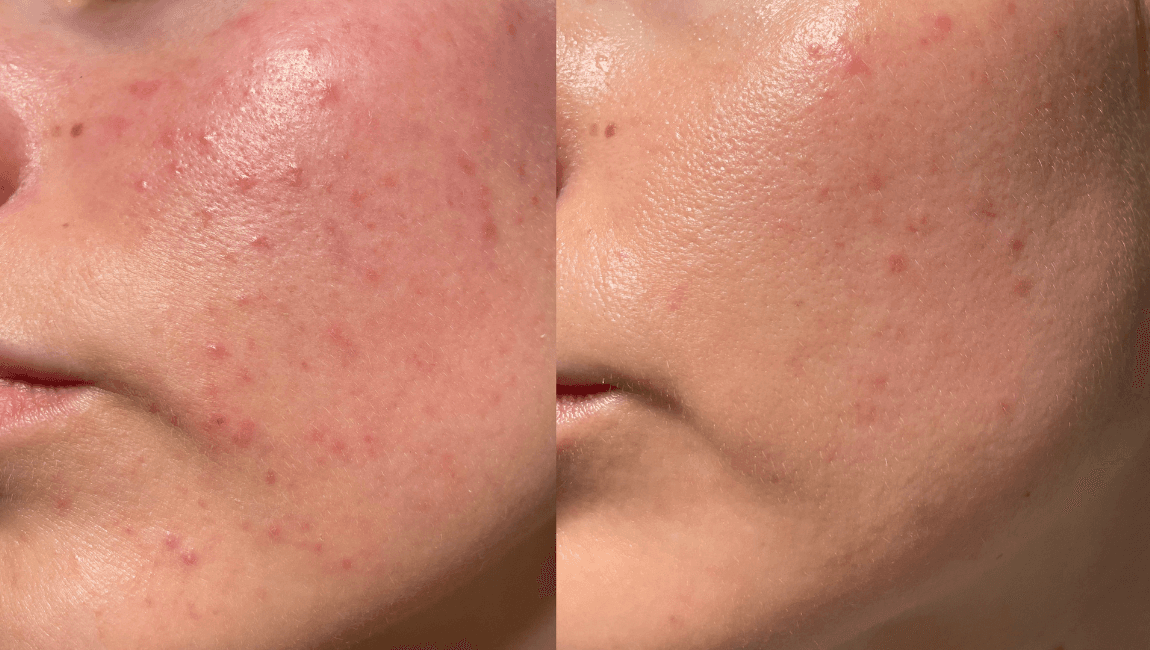 Best K-Beauty Ingredients for Controlling Sebum and Preventing Shine