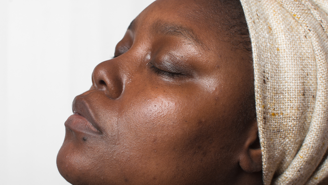 Top 5 Tranexamic Acid Serums Perfect for Hyperpigmentation