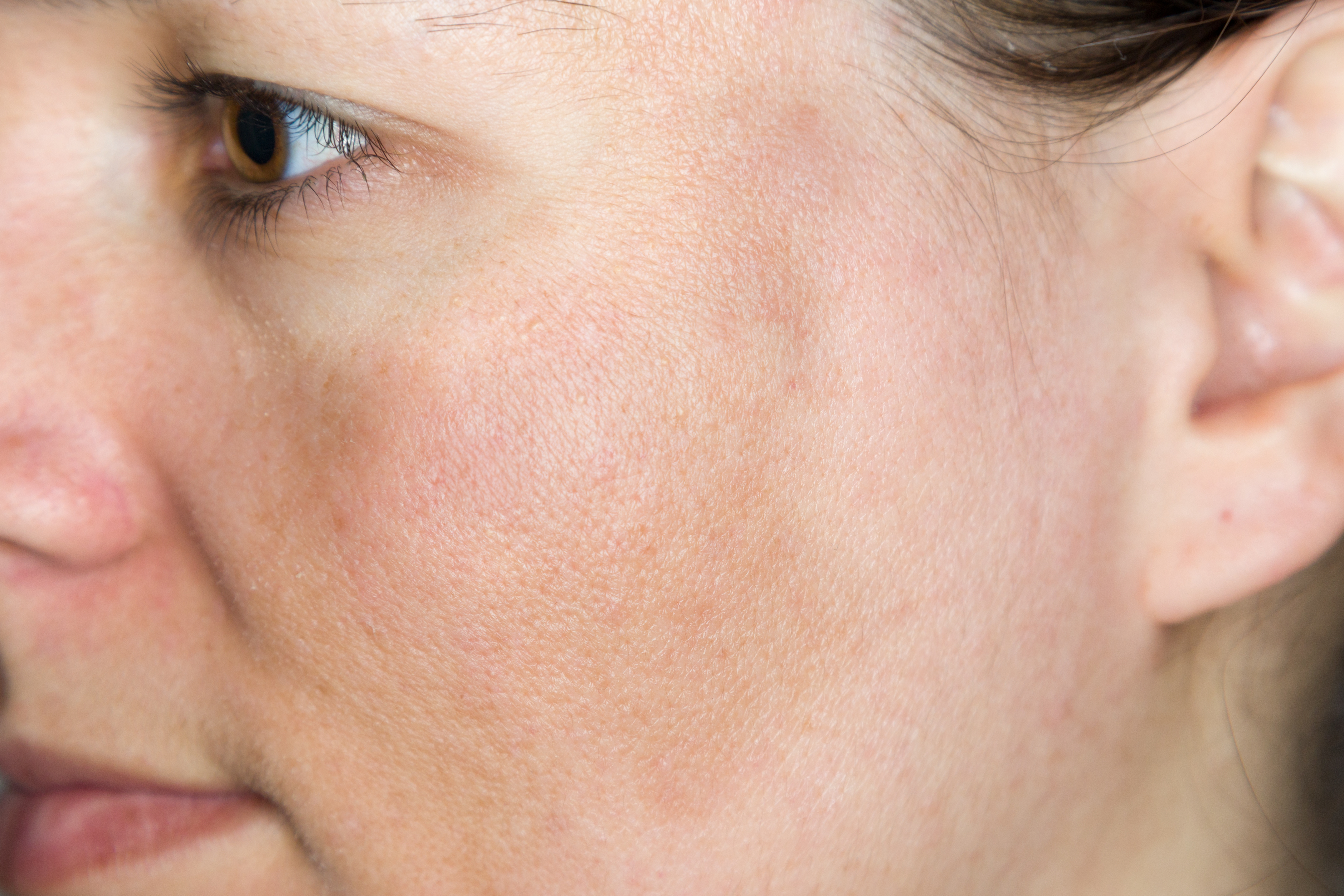 Hyperpigmentation