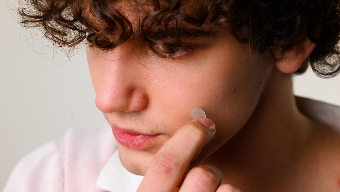 The Complete Guide to Pimple Patches: Do They Really Work? - SKINSIDER