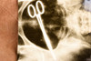 Surgical Hemostat Left in Woman 12 Years Cleveland X-Ray 6⅜x9 1947 AP Wire Photo V39