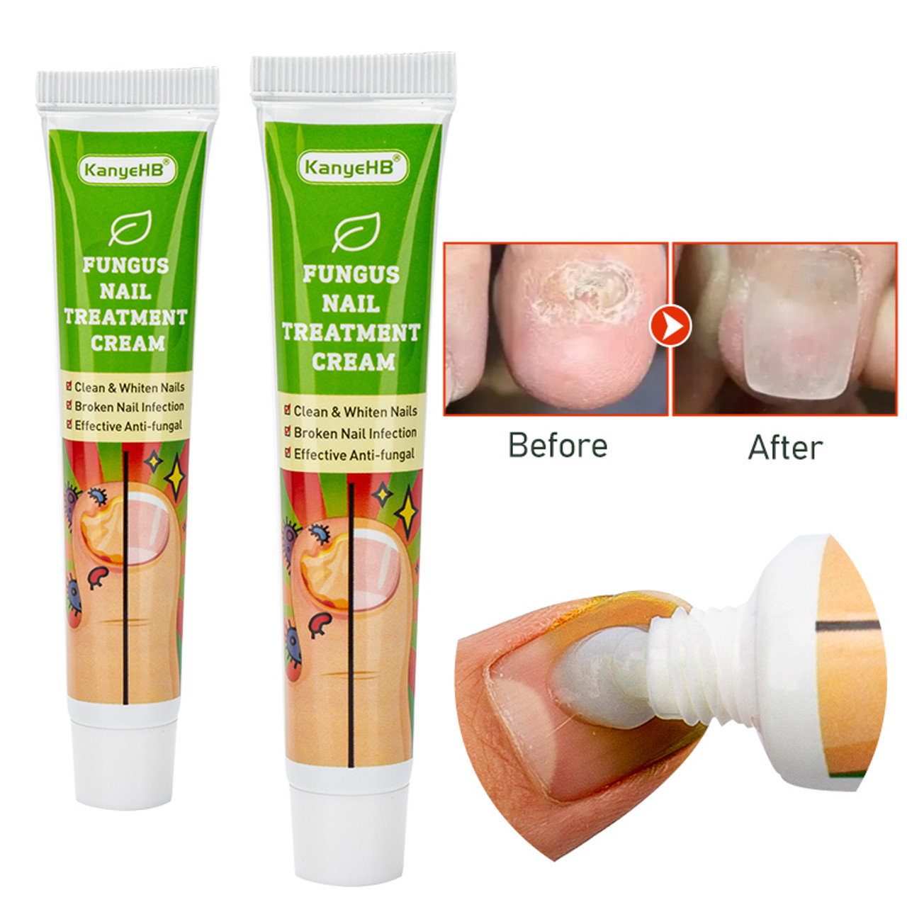 Finger Nail Infection Cream - Temu