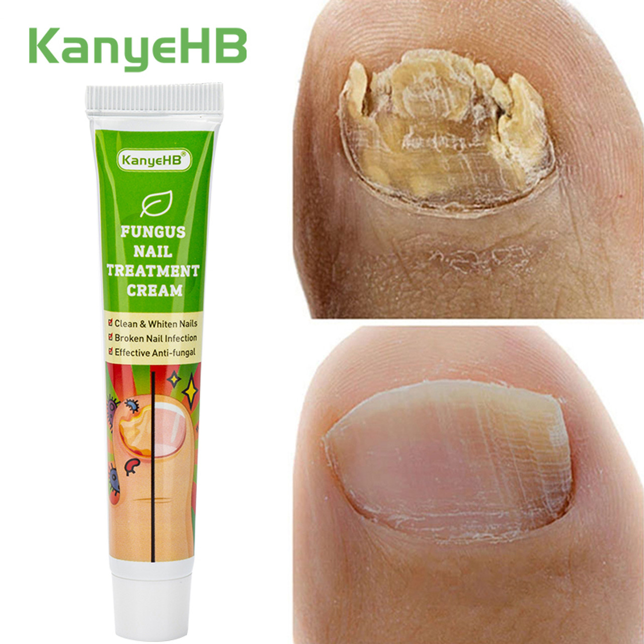 2/3pcs Nail Fungus Treatment,toenail Fungus Treatment Serum Cream,toe  Repair Gel Anti-infection Onychomycosis Paronychia Care Ointment | Fruugo KR