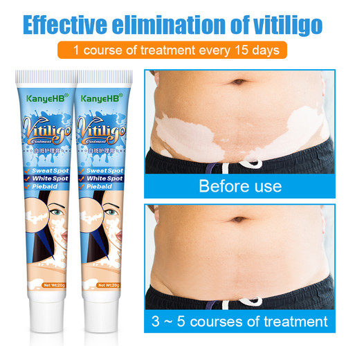 Vitiligo Ointment Psoriasis Mycosis Leukoplakia Antibacterial Anti-itch Relief Pain Treatment Cream