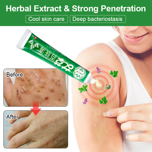 Herbal Psoriasis Cream Relief Itch Dermatitis And Eczema Pruritus Psoriasis Treatment Ointment