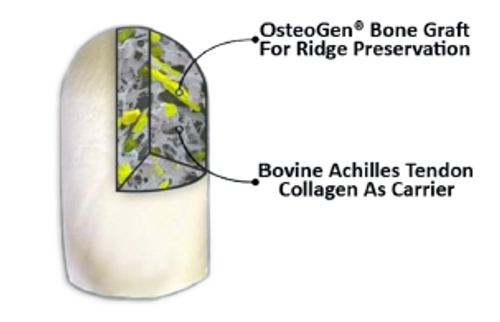 Puragraft Osteogen Plug, 15mmx20mm, X-Large, 5/bx