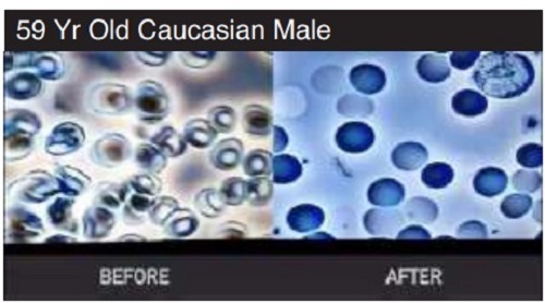 Hydrogen Oxygen Nanobubble Bath Clinical Study