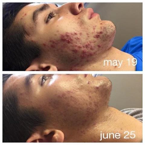 5weekscellumaacne.jpg