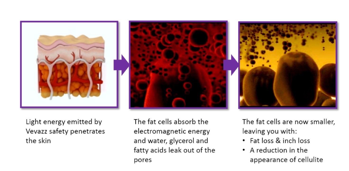 red light laser for weight loss