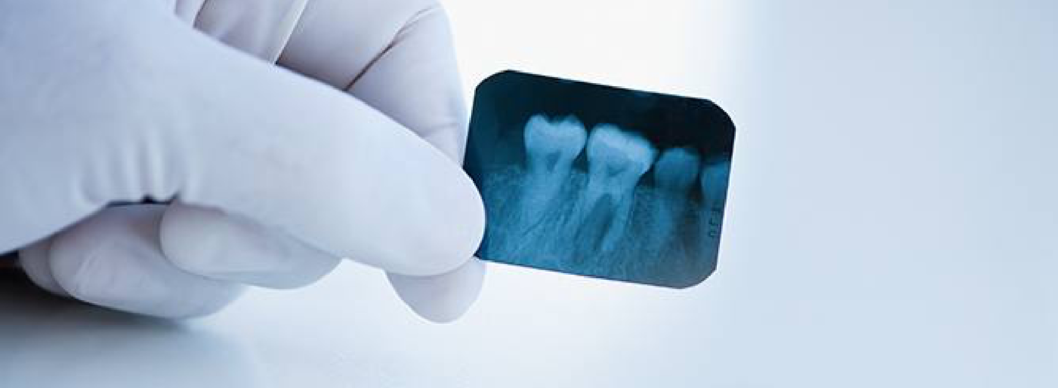 types of impacted wisdom teeth