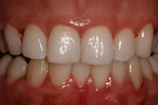 What Do Healthy Gums Look Like Crest