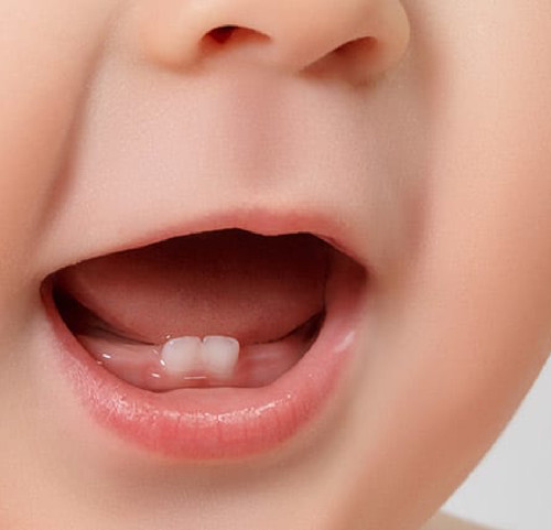 decalcification in baby teeth