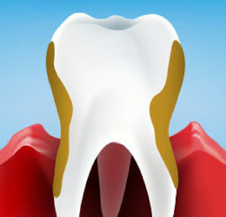 Bleeding Gums: Causes, Treatment, and Prevention - SmartMouth