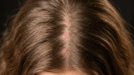 Psoriasis, eczéma, dermite : ce que votre coiffeur peut faire (et pas faire)