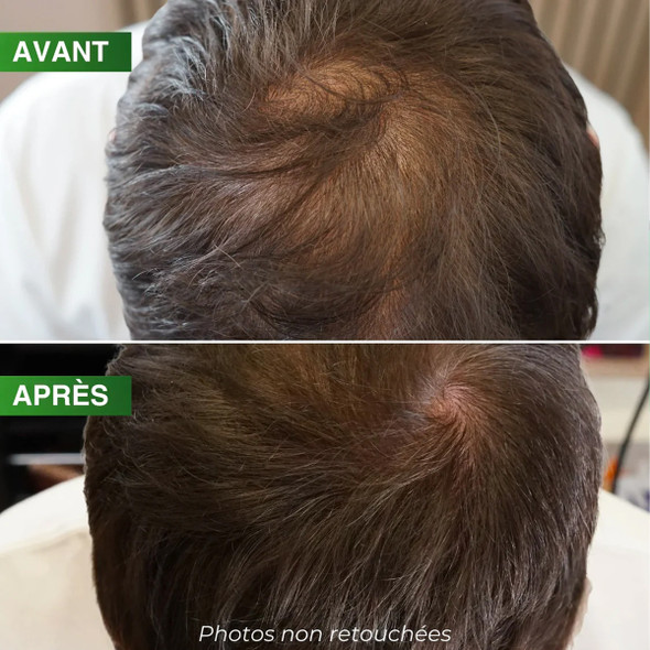 Ampoules Revitalisantes Prévention Chute Densité Pro BBHair Générik 10x10 ml