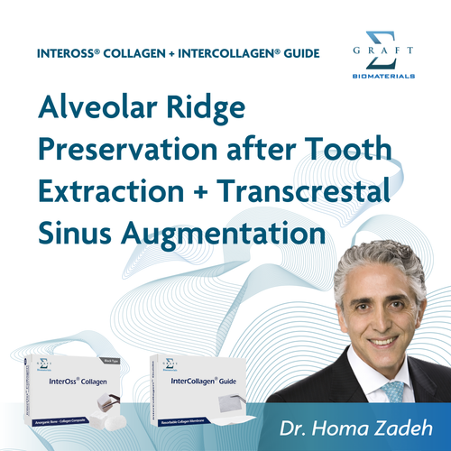 Alveolar ridge preservation after tooth extraction and transcrestal sinus augmentation, by Dr. Homa Zadeh (PDF, opens in a new tab)