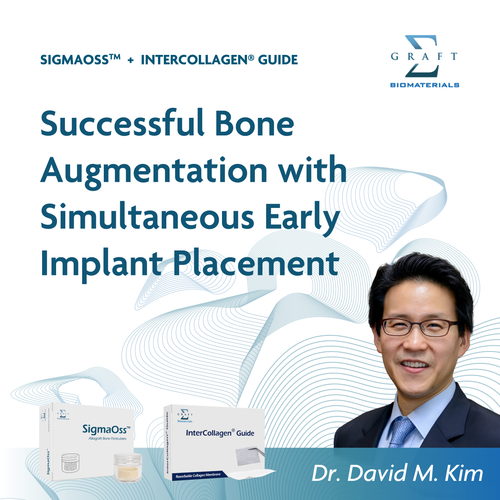 Successful bone augmentation with simultaneous early implant placement, by Dr. David M. Kim (PDF, opens in a new tab)