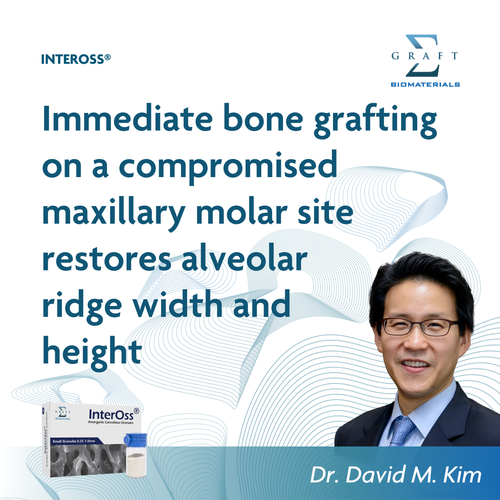 Immediate bone grafting on a compromised maxillary molar site restores alveolar ridge width and height, by Dr. David M. Kim (PDF, opens in a new tab)